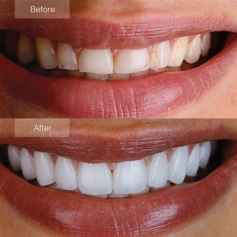 porcelain veneers in burnsville mn|Porcelain Dental Veneers .